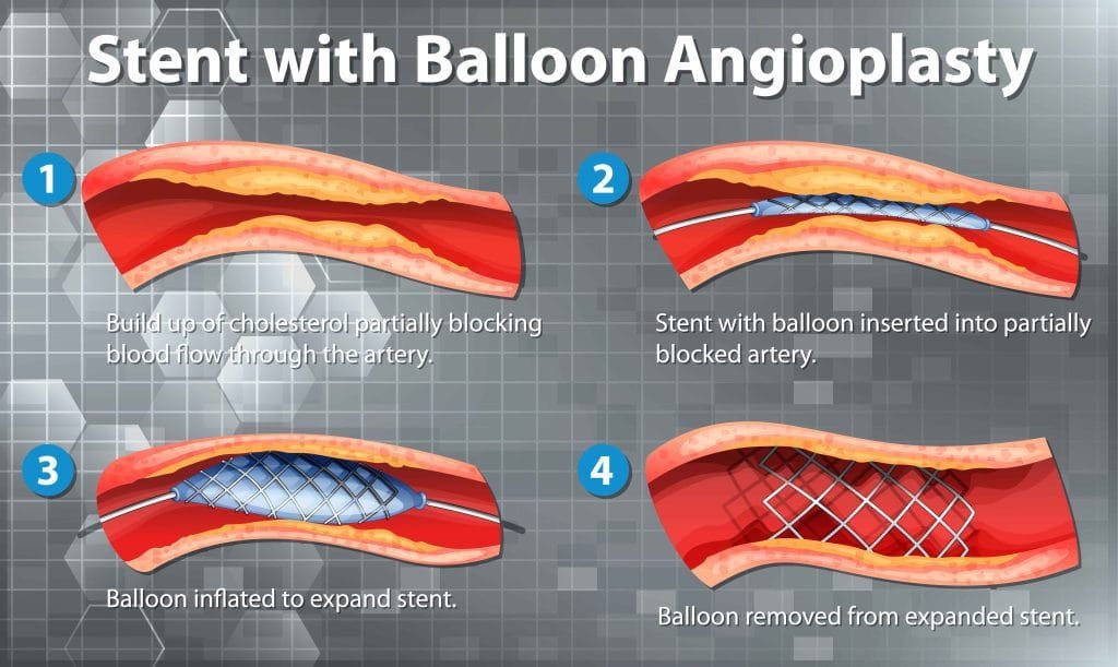 balloon angioplasty and stent placement