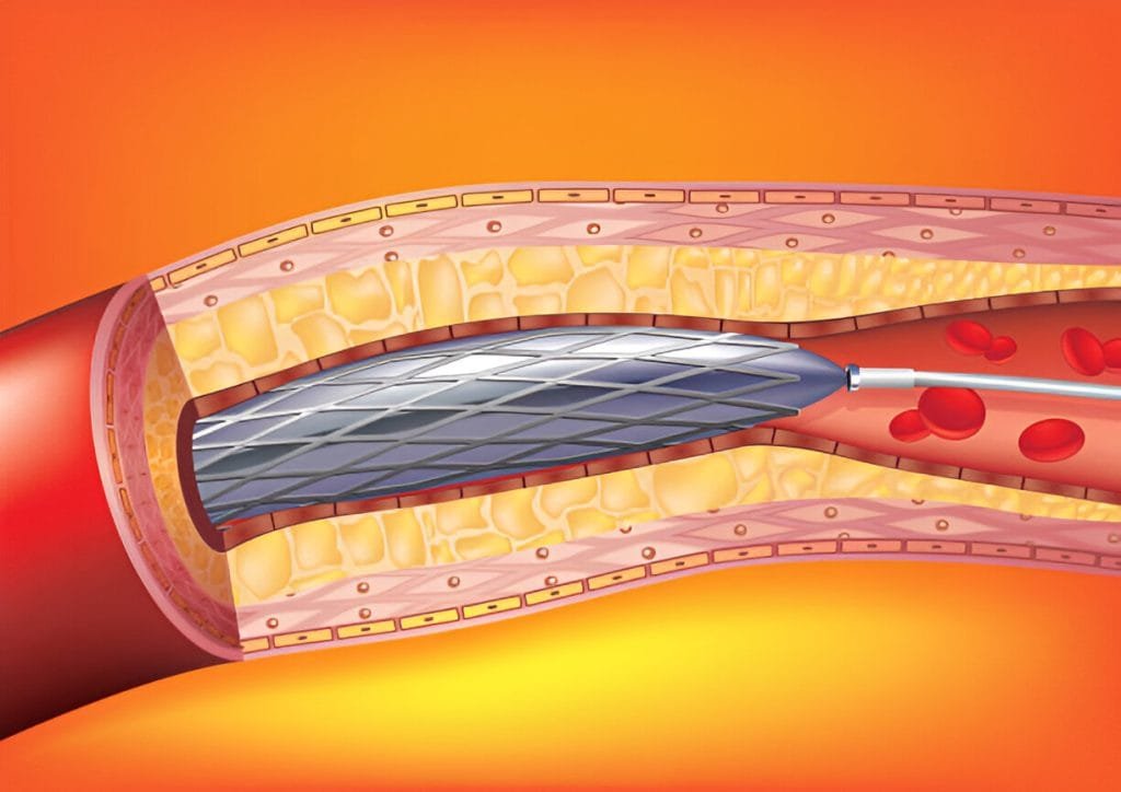 Stent Placement